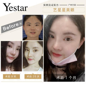 艺星星美颜术后1月返图【曾繁茂院长】