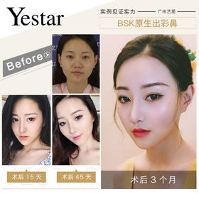 鼻综合-术前术后对【佘高明】