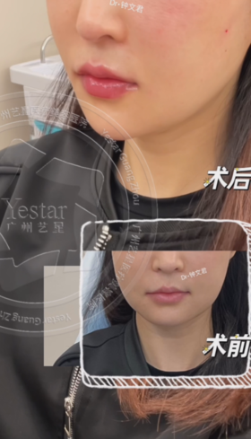 丰唇术前术后对比【钟文君主任】
