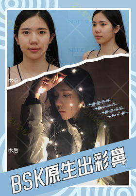 BSK原生出彩鼻【佘高明院长】