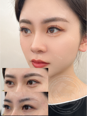 王雯婷院长-恋恋桃花眼卧蚕＋双眼皮加宽