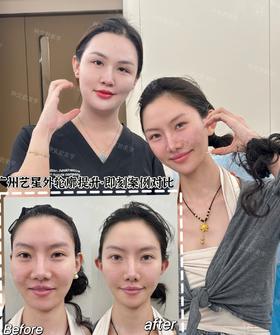 外轮廓提升【钟文君案例】