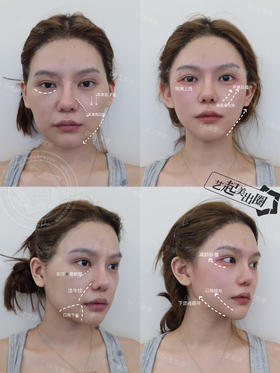 骨量增强-眉弓【王雯婷院长】