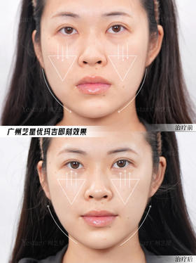 清华研发国产优玛吉