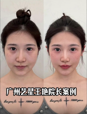 微do即刻提高面部平整度和折叠度☑ 憔悴凹陷脸秒变元气甜妹🥰