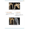 实用髓内钉治疗学 第2二版 王秋根 王庚启 主编 详细介绍四肢长骨如肱骨 股骨和腓骨骨折的髓内钉治疗等 北京大学医学出版社 商品缩略图4