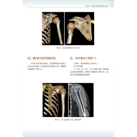 实用髓内钉治疗学 第2二版 王秋根 王庚启 主编 详细介绍四肢长骨如肱骨 股骨和腓骨骨折的髓内钉治疗等 北京大学医学出版社 商品图4
