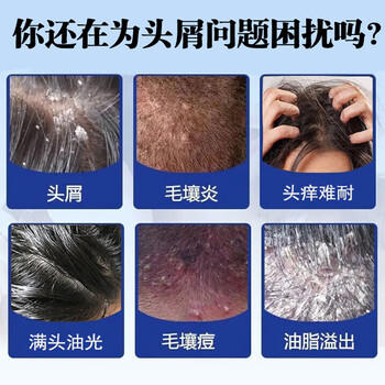 宫本武藏二硫化硒去屑洗发水脂溢性去屑止痒控油毛囊清洁洗发水痘300ml /个人护理 /洗发护发 /洗发水 商品图0