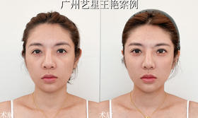 #童颜针#眼周年轻化