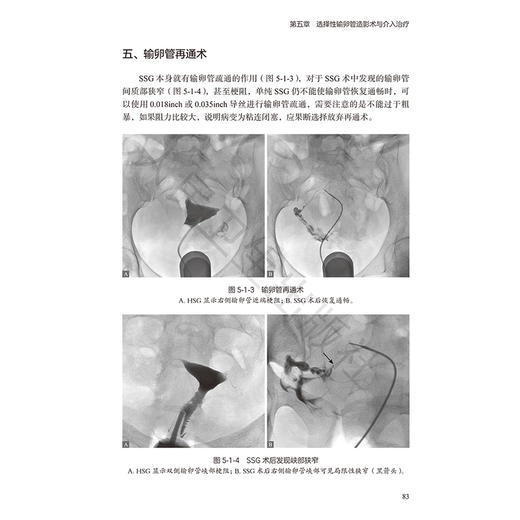 输卵管性不孕的放射介入诊疗 郑国 苗杰 主编 内容包括了输卵管性不孕的基础理论知识 放射医学 西医9787117380287人民卫生出版社 商品图4