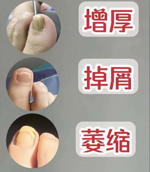 日本独家配方【山M同款ManrubensMken灰指甲液】灭菌修护一把抓，从根源解决所有问题，真正做到除灰甲、不复发! 商品图3