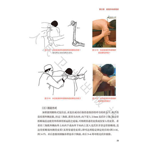 闭合复位技术在四肢骨折治疗中的应用 第2二版 张铁良 特别着重介绍了近年来闭合复位的新技术 大量图片 图文并茂 人民卫生出版社 商品图4