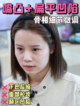 博主“可可欧阳”do脸方案公开！嘴凸+下巴后缩女孩的提升思路来啦