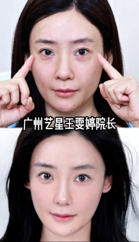 长中庭高眼位看过来 调整面部比例→重塑视觉中心💫 这样微调太可了☑