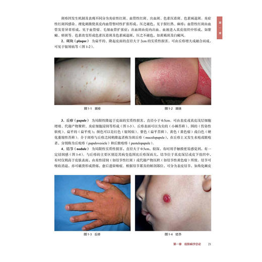 皮肤病与性病学 第2二版 晋红中 主编 本教材介绍常见皮肤病与性病的病因 发病机制 临床特点 鉴别诊断等 中国协和医科大学出版社 商品图4