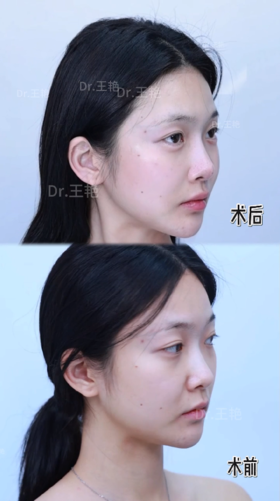 阔面脸变小脸❗ 苦相倦容通通消失 这效果爱了爱了💓