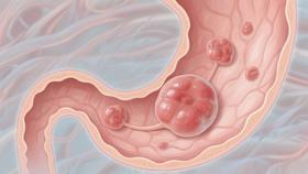  李雪琴切除8个胃息肉引热议！指南级解读来了