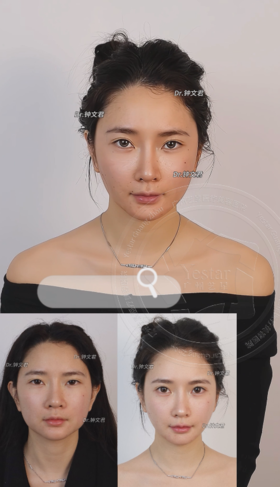 气质微整轮廓固定*恋恋桃花眼|骨相立体+皮相紧致