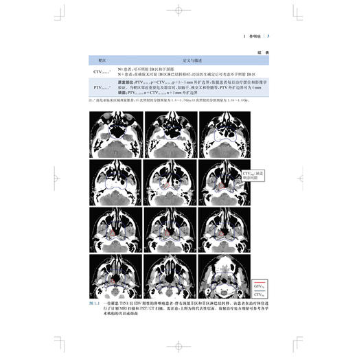 肿瘤放射治疗靶区勾画与射野设置：适形及调强放射治疗实用指南 原著第2二版 孔琳 主译 9787547872130 上海科学技术出版社 商品图4