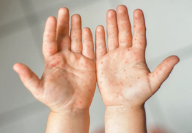  刚开学2天，娃就高烧腹泻？这4种秋季“校园传染病” 早识别早预防，家长别慌！