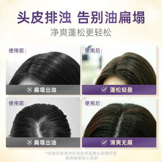 清仓【2件49元】卓蓝雅婍迹按摩膏380ml 去屑止痒 舒缓头皮 深层清洁 疏通毛囊 商品图3