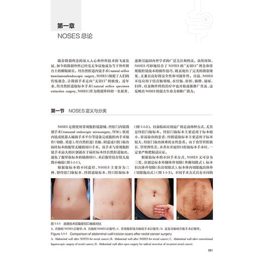 经自然腔道取标本手术基础与培训 胃肠外科 王锡山 丁克峰 内容包括总论术前准备腹腔镜结直肠NOSES腹腔镜胃NOSES等人民卫生出版社 商品图4