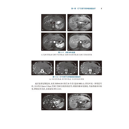 肝脏肿瘤消融治疗案例精析 肿瘤消融治疗技术规范化培训配套教材 范卫君 主编 参考书 西医 肿瘤学 9787117380683 人民卫生出版社 商品图4