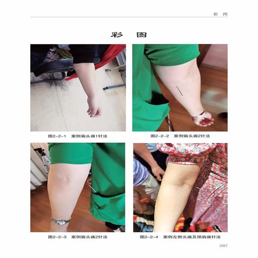 本性针灸临证心悟 于本性 主编 经络平衡针法 解决经络病人迎寸口脉针法 解决多种内科疾病 9787559141446 辽宁科学技术出版社 商品图3