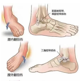 【恢复课堂】 崴脚不疼≠没事！崴脚后遗症！小心这些隐患毁了你的平衡！