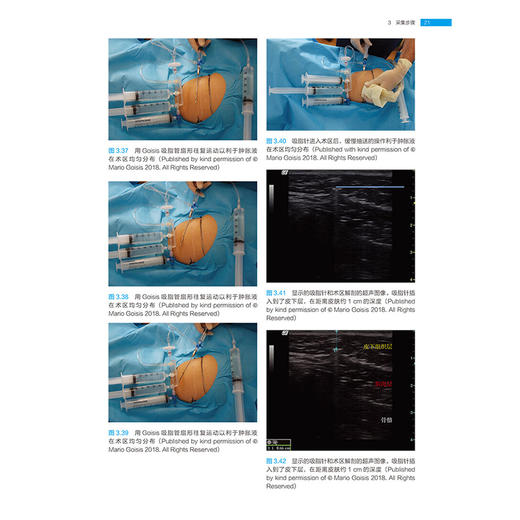 再生医学 脂肪与PRP注射门诊应用指南 黄昕昕 刘晓燕 适合于从事再生治疗的皮肤科整形科烧伤科医生阅读的参考书辽宁科学技术出版社 商品图4