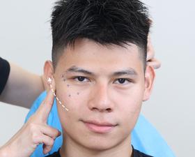 苹果肌下垂显老？3 个点位提拉法