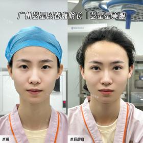 宝子以前埋线掉了一只 特地飞来广州找段春巍院长do双眼皮👀