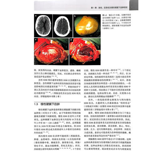 硬膜下血肿 过去、现在与未来的临床管理 刘伟明 吴量 急性 亚急性及慢性硬膜下血肿综述 慢性硬膜下血肿与癫痫北京大学医学出版社 商品图4