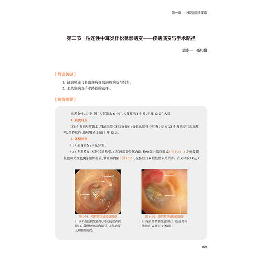 耳显微外科病案精解 刘阳 赵辉 主编 约20幅高清临床图片 图文并茂 供耳科临床医师参考 西医 耳鼻咽喉科学 人民卫生出版社 商品图4