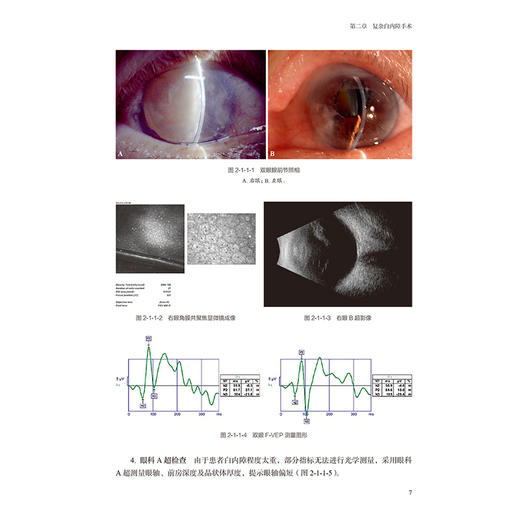 复杂白内障手术：病例解析与临床思辨 赵云娥 主编 本书对不同的复杂白内障病例的诊疗过程进行辨析 9787117384704人民卫生出版社 商品图4