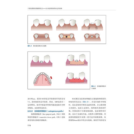 【出版社直发】口腔软硬组织增量新纪元——血小板浓缩物临床应用指南 周延民 付丽 王林 9787559141989辽宁科学技术出版社 商品图3