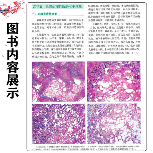 手术中病理诊断图鉴 第3三版 笪冀平 主编 远程手术中冷冻切片病理诊断与质量控制 甲状腺疾病 9787523522851科学技术文献出版社 商品图4