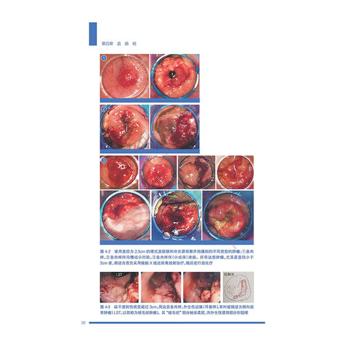 接触X线近距离放射治疗 周福祥 彭晋 主译 系统论述50kV浅层X线治疗机的放射物理基础 治疗原理 9787117384865 人民卫生出版社 商品图4