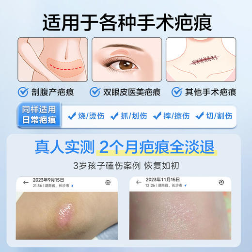 可孚医用祛疤膏硅酮凝胶去疤痕修复除疤剖腹产手术增生儿童去疤膏 商品图3