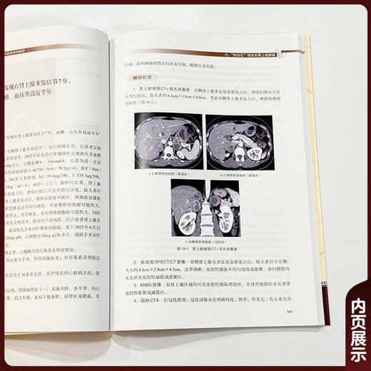 协和泌尿外科大查房 肾上腺外科疑难病例 王文达 涵盖了肾上腺原发的继发的以及与肾上腺相关的多种疾病 中国协和医科大学出版社 商品图4