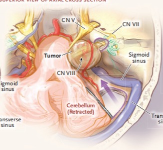 枕下乙状窦后-经内听道入路 全面观察