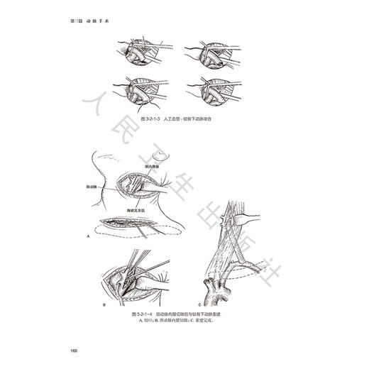 血管外科手术学 第2二版 梁发启 附视频 深度剖析血管外科手术全链条从解剖精要到并发症处理从传统术式到微创介入 人民卫生出版社 商品图4