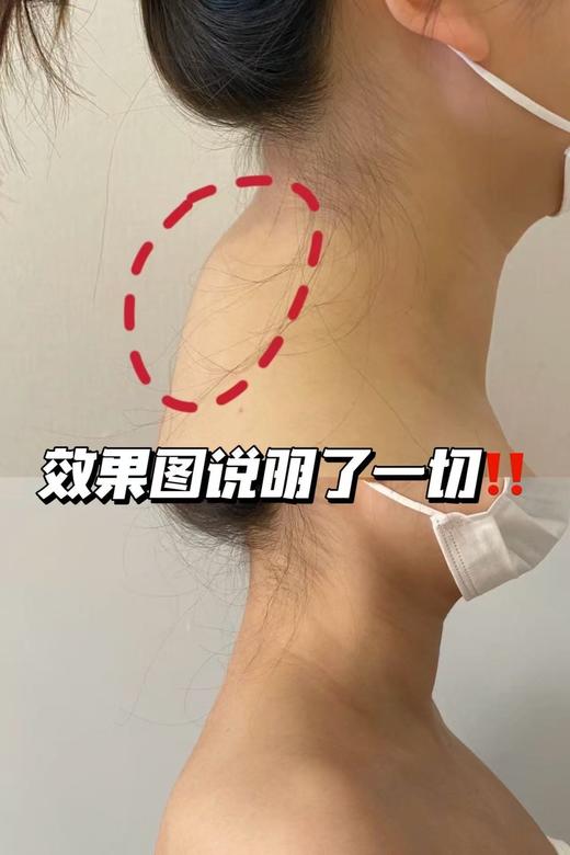 秒杀福利！【日本院线级！富贵包靶向 | 颈酸鼓包速疏 | 肩颈舒缓】日本富贵包神器颈椎酸胀鼓包疏通肩颈不适专用贴。hb 商品图1