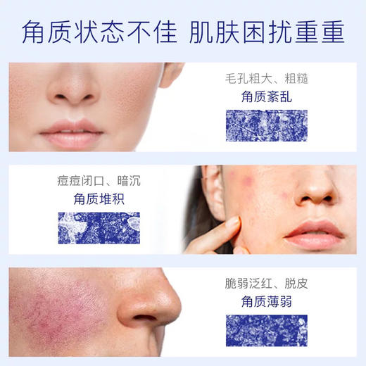 TAKAMI小蓝瓶精华液祛痘温和精华角质养护去闭口10ml 商品图2