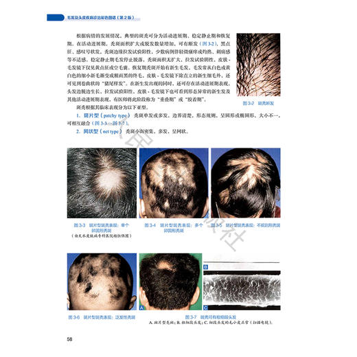毛发及头皮疾病诊治彩色图谱 第2二版 侯显曾 杨淑霞 黄卫宁 主编 毛发头皮疾病的病理表现 皮肤镜（毛发镜）等 人民卫生出版社 商品图4