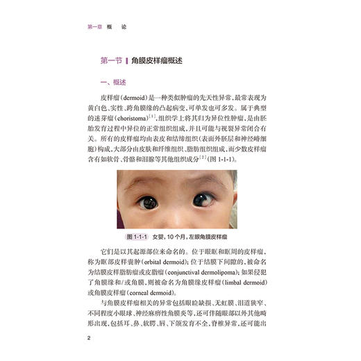 角膜皮样瘤（眼表疑难病口袋书系列）蔺琪 潘志强 主编 附赠5个高清视频 病因与组织病理学 角膜皮样瘤的流行病学 人民卫生出版社 商品图4