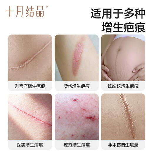 医用硅酮产后妊娠纹药膏修护祛疤凝胶烫伤疤痕增生专用 商品图2