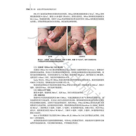 激光美容治疗学 杨森 杨蓉娅 肖嵘 刘永生 主编 全面介绍激光美容领域中能量设备 作用机制 疗效及注意事项 等 人民卫生出版社 商品图4