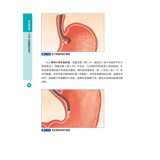 消化道早癌ESD 必备基础与技巧 商品图4