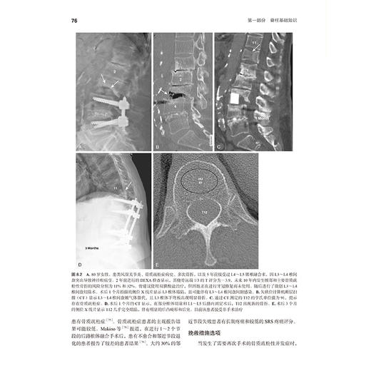 本泽尔脊柱外科学 第5五版 罗卓荆 李危石 杨操 黄景辉 李方财 魏富鑫 主译 脊柱病 外科学骨科学9787565934889北京大学医学出版社 商品图4